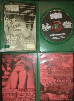 Wrong Illegal Abortion Procedure With Alarming Consequences : Gangrene Discharge - Pilocystic Astrocytoma - WxIxAxPxWxAxCx